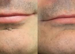 ✨Coredew®2-in-1 Microneedle & Hydrocolloid Patch🍀| Removes Raised Moles, Acne, Flat Warts & Skin Tags | Helps Improve Wrinkles, Scars & Blemishes | Invisible Patches for Face & Body