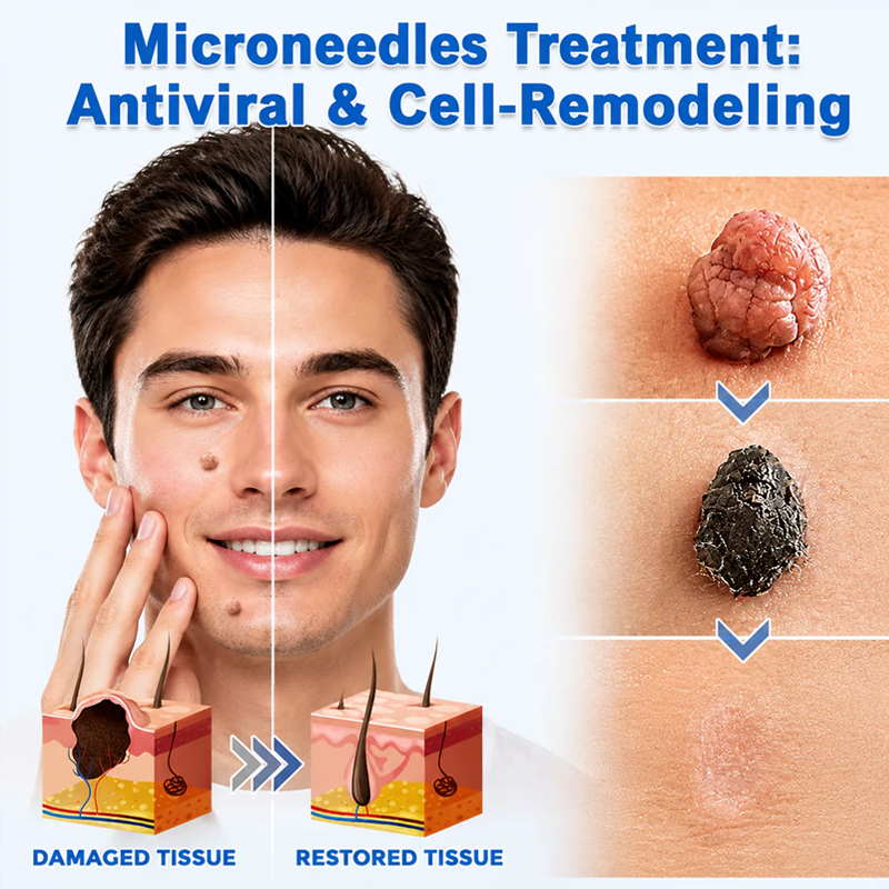 ✨Coredew®2-in-1 Microneedle & Hydrocolloid Patch🍀| Removes Raised Moles, Acne, Flat Warts & Skin Tags | Helps Improve Wrinkles, Scars & Blemishes | Invisible Patches for Face & Body