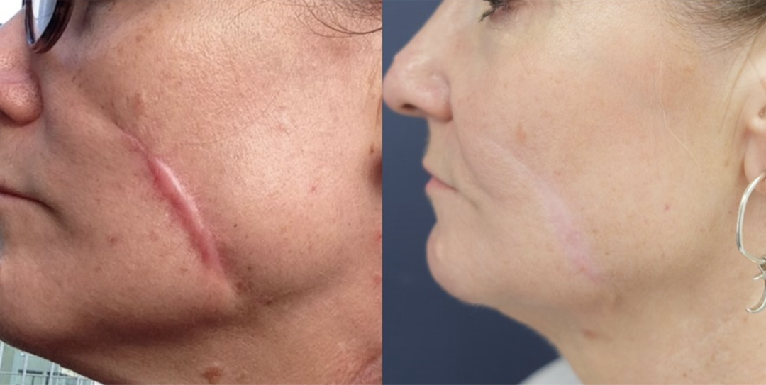 🔥Last Day Discount🔥 Coredew® DERMALUX Texture Repair Gel